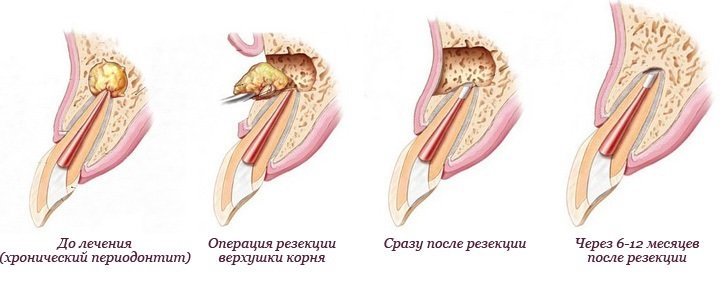 резекция корня зуба