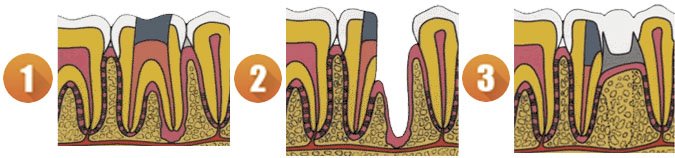 короно-радикулярная сепарация зуба