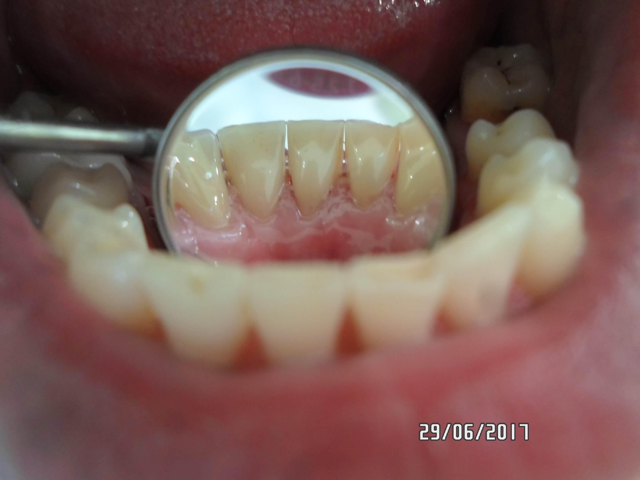 Профессиональная чистка зубов в Самаре Клиника Доктора Мут
